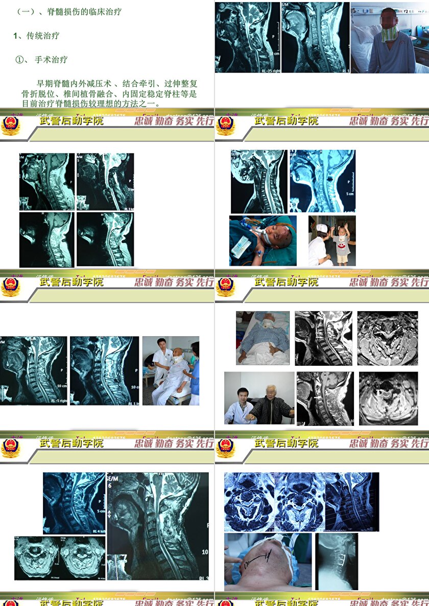 2023年脊髓損傷研究新進展，里程碑式的突破與日常奇妙變化