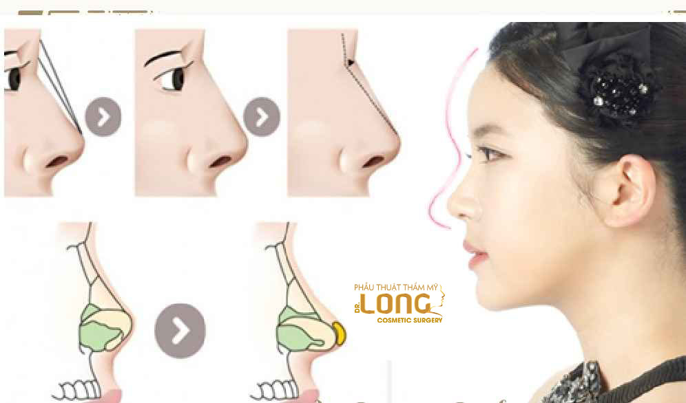 最新鼻整形技術重塑自信，煥發(fā)新生之美