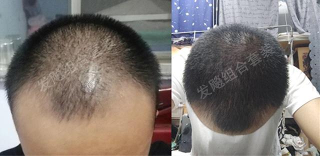 治愈脫發(fā)最新重大突破，重塑自信，希望之光再現(xiàn)