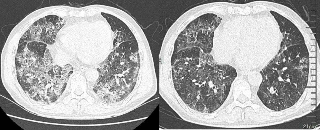 科技前沿高科技產(chǎn)品助力新冠心肺炎抗疫之路最新進展